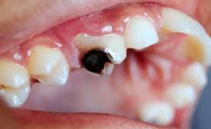 A Tooth Is Badly Decayed or Broken